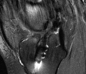 Revision ACL Intact but Lax Graft